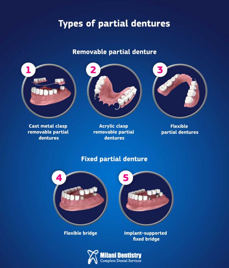 Types of Dentures